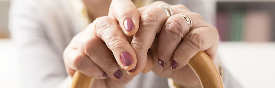 Hands of a woman with myositis